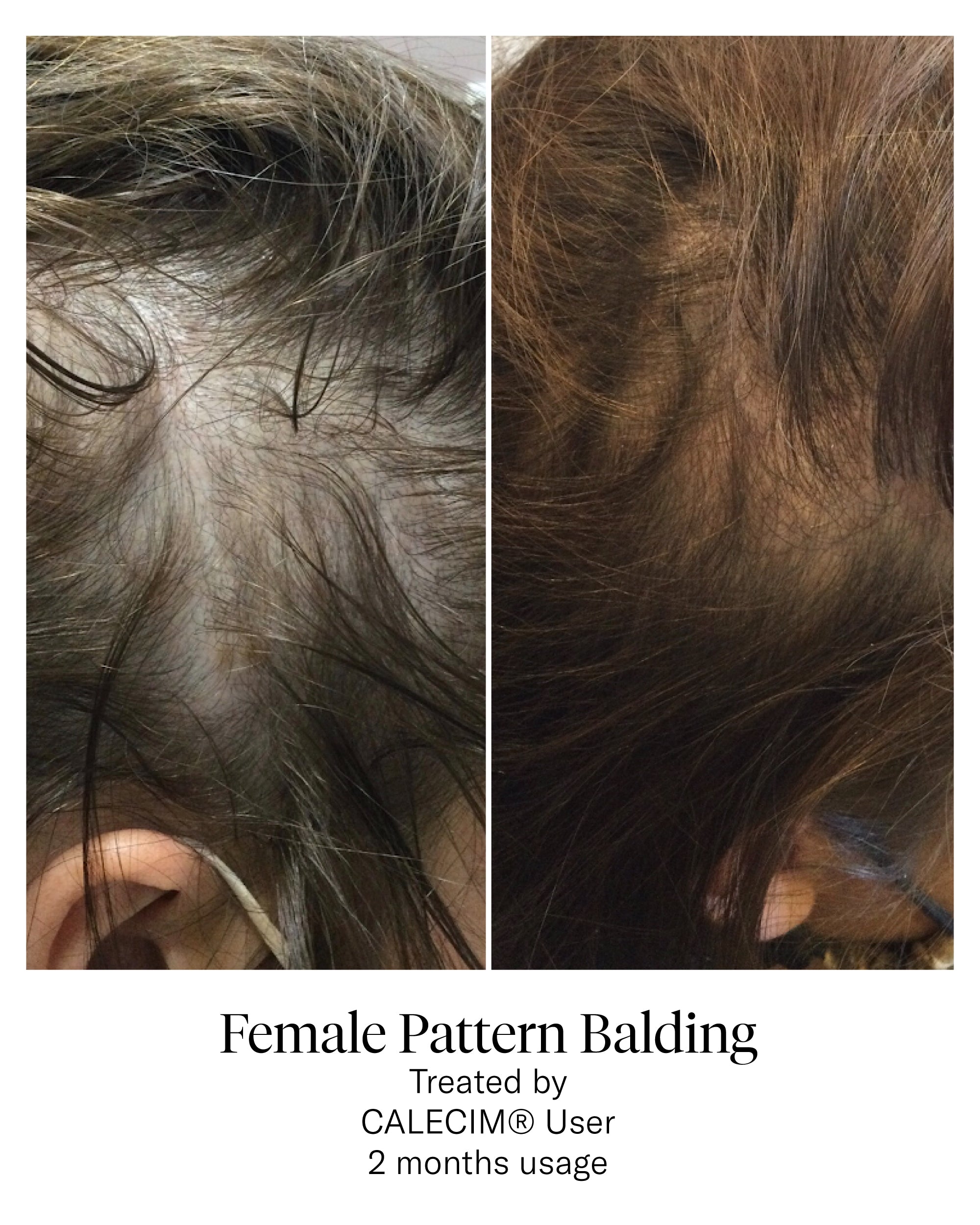 CALECIM®︎プロフェッショナル ヘアセラム 5mL×6本